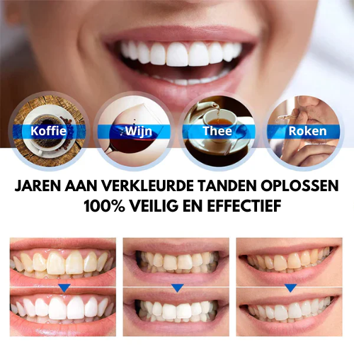 PureSmile™ - Tandenbleekpen (1+1 GRATIS)