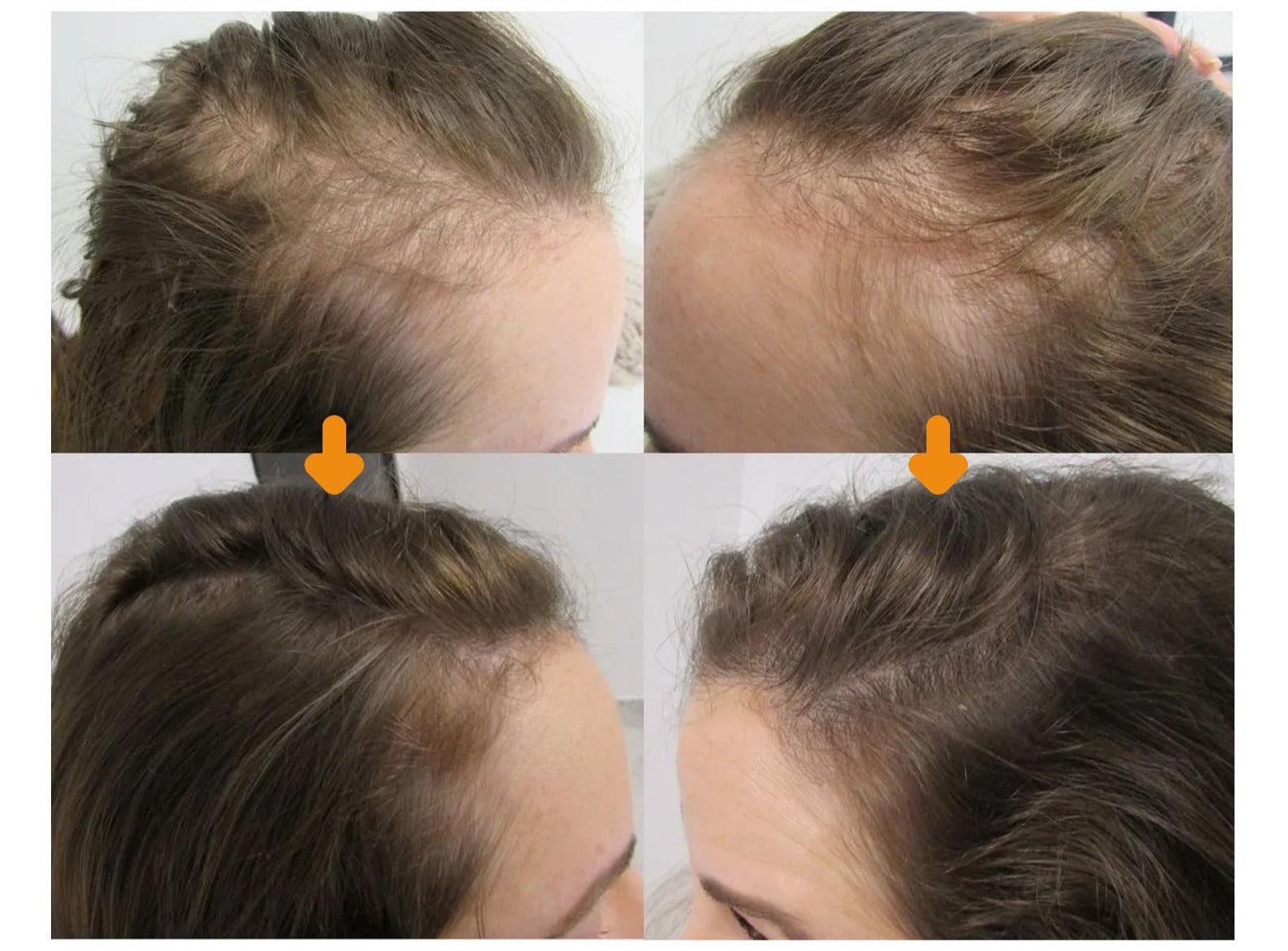 Biopurc ™ hair growth oil (1+1 free)