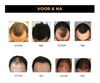 HairFix™ | Geen kale plekken meer!