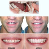 HappyBite ™ - adjustable dentures for a cheerful smile | Last day 75% discount